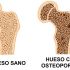 5. Aumentan el riesgo de sufrir osteoporosis