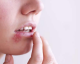 Herpes labial: alimentos que debes comer y los que debes evitar