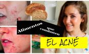 ¡Estos 7 alimentos te ayudarán a combatir el acné de tu cara!