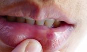 ¿Cómo curar las llagas y úlceras en la boca?