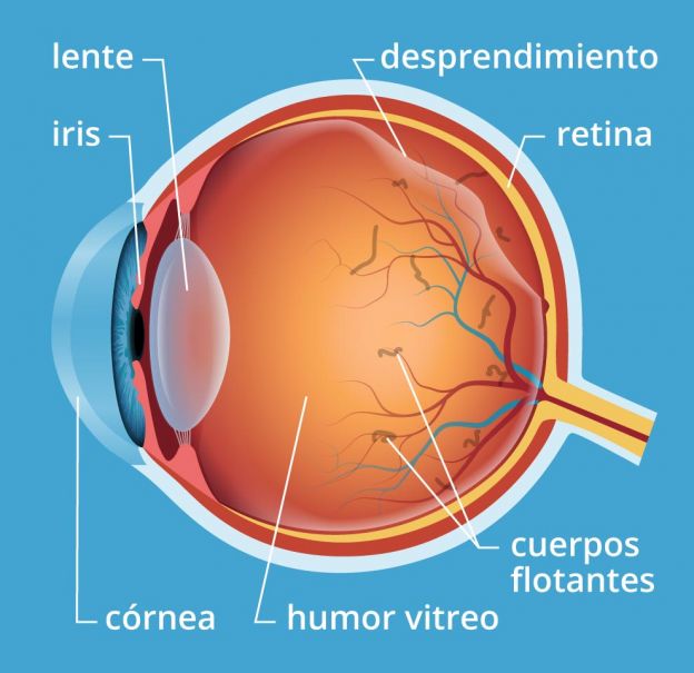 ¿qué causa las miodesopsias?