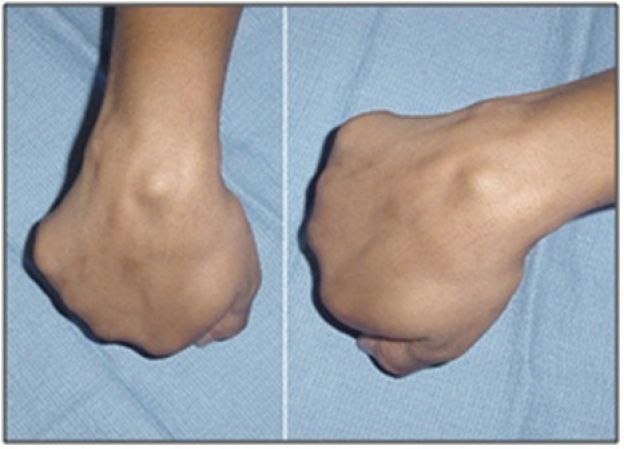 3) Enfermedad de quervain