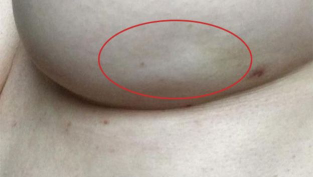 Los síntomas del cáncer de mama