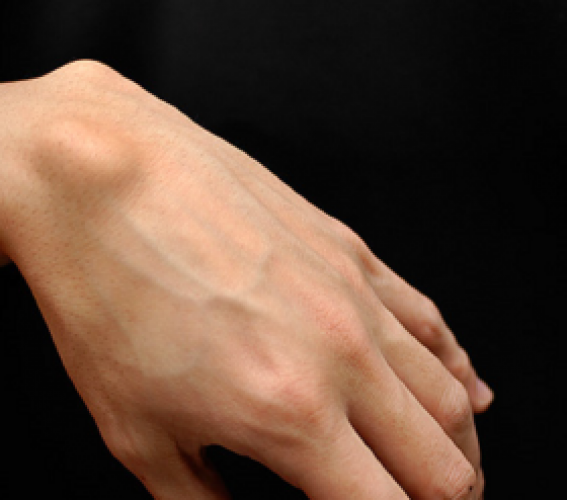 2) tenosinovitis nodular