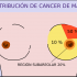 Los síntomas del cáncer de mama