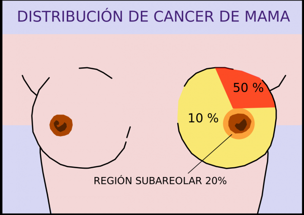 Los síntomas del cáncer de mama