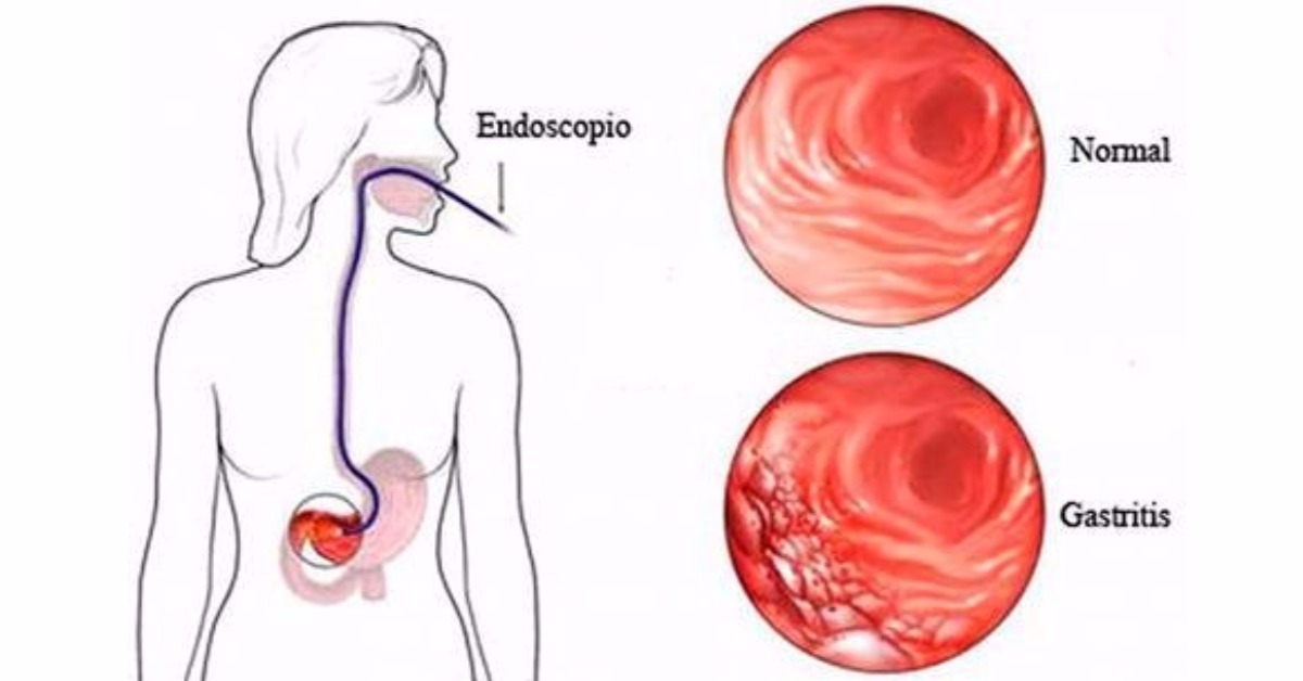 дуоденит гастроскопия. эзофагогастродуоденоскопия язвенная болезнь желудка. гастроскопия желудка гастрит. гастроскопия желудка гастрит. хронический гастрит фгдс.